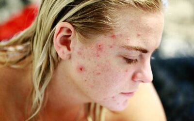 CBD pour votre peau : bienfaits, risques, mode d’action, meilleurs produits