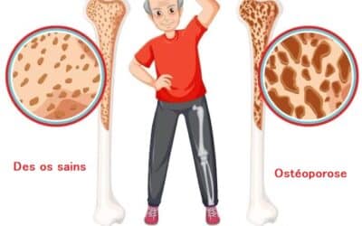 CBD et ostéoporose : une révolution ? (ce que vous devez savoir)