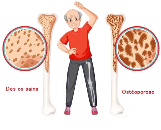 CBD et ostéoporose une révolution 